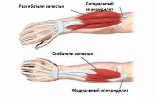 Растяжение связок локтевого сустава: клиника, причины, лечение и возможные осложнения