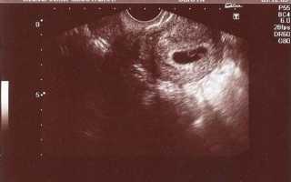 7 недель беременности: размер плода и фото УЗИ