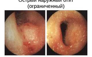 Симптомы наружного отита и как его вылечить?