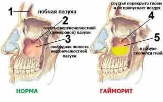 Как отличить гайморит от насморка