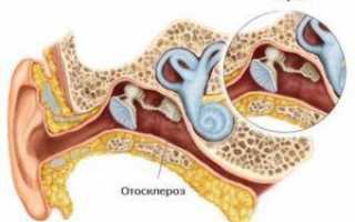 Как выявить и вылечить отосклероз уха?