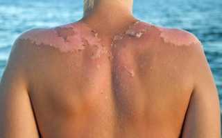 Солнечный дерматит: что это такое и насколько он опасен