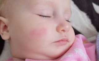 Возможные причины красных пятен на лице у ребенка