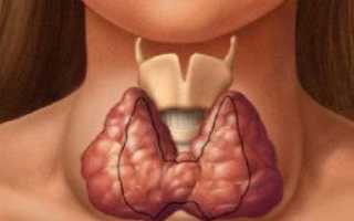 Лечение зоба щитовидной железы