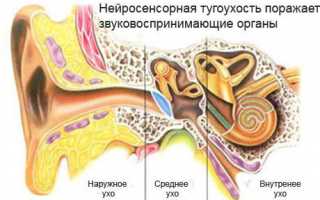 Что такое кондуктивная тугоухость и как её лечить?