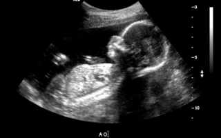 22 неделя беременности фото: УЗИ девочек