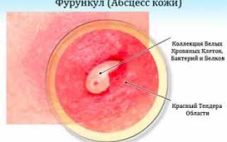 Как лечить фурункул в ухе?