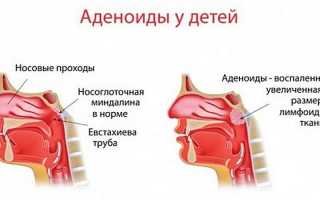 Что делать если у ребенка сопит нос но соплей нет?