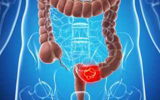 Как питаться после оперативного вмешательства на прямом кишечнике