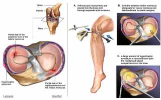 Разрыв мениска коленного сустава – что мы знаем о нем