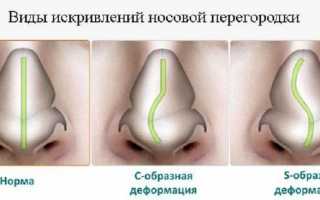 Как проходит операция по выпрямлению носовой перегородки?