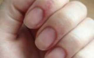 Опасный маникюр — аллергия от гель-лака