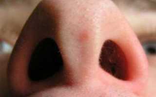 Как лечить гипертрофию слизистой носа?