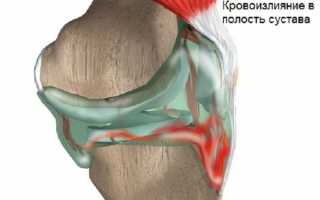 Гемартроз коленного сустава: симптомы, причины и методы лечения