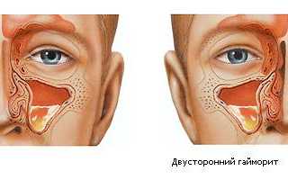 Что делать если при гайморите заложило ухо?