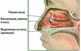 Что такое полипоз носа?