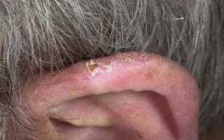 Как распознать опухоль уха и как она выглядит?