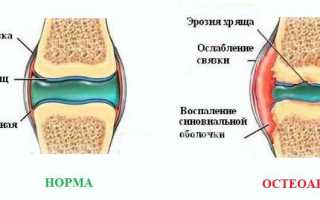 Внутрисуставные уколы – смазка для суставов, облегчающая болевой синдром