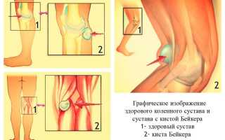 Киста Бейкера коленного сустава: особенности этиопатогенеза и способы коррекции