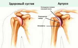 ДОА плечевого сустава: степени и виды, причины, симптомы, диагностика, лечение