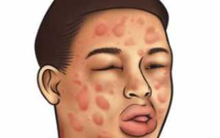 Когда требуется другой анестетик: аллергия на лидокаин