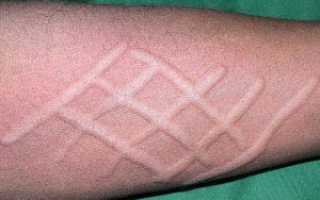 Дермографическая крапивница: когда аллергия проявляется полосами на теле