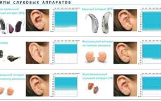 Кому положен слуховой аппарат бесплатно?