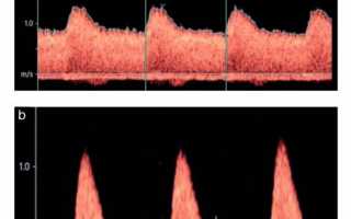 Для чего необходима допплерометрия?