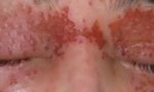Что нужно знать об аллергии на лице и о способах борьбы с ней