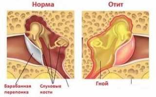 Особенности развития и эффективные методы лечения острого ринита