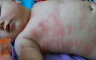 Аллергия на кабачок — даем в знаниях скачок