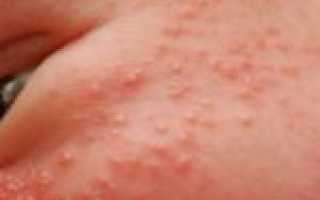 Аллергия на памперсы — что следует знать мамам