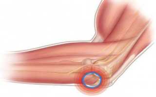 Воспаление локтевого сустава: причины, симптоматика, помощь