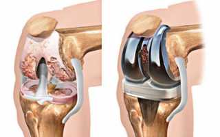 Эндопротезирование коленного сустава: когда оно необходимо, виды протезов, подготовка к операции
