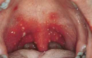 Как лечить сифилис в горле