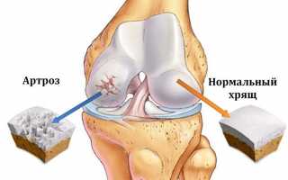 Артроз суставов: виды, симптомы, лечение