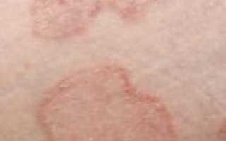 На коже спины шелушение: в организме нарушение